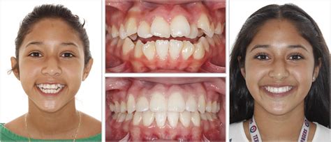 Before and After - Hodges & Hodges Orthodontics | Amarillo Canyon Plainview TX