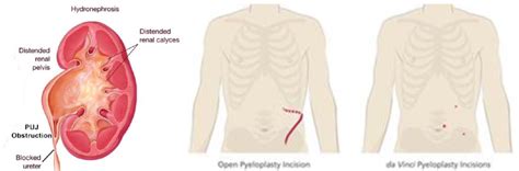 Robotic Pyeloplasty | Chin Chong Min Urology & Robotic Surgery Centre