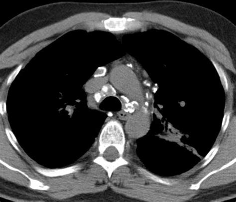 Faces of Calcified Mediastinal Nodes | Lungs