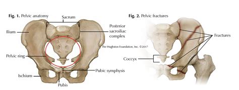 Pelvic Fractures - Florida