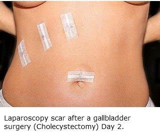 Laparoscopy Pictures