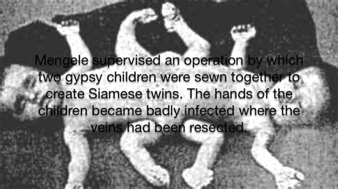 Josef Mengele Twins Sewn Together