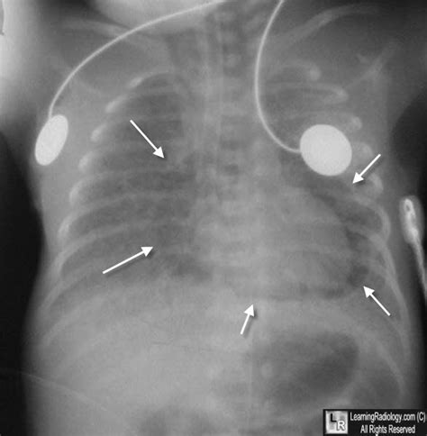 Learning Radiology - Pneumopericardium