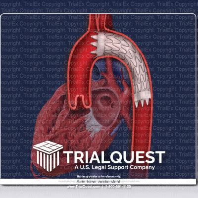 Aortic Stent - TrialExhibits Inc.