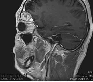 Cerebral MRI showing the contact of the left frontal sinus tumor with... | Download Scientific ...