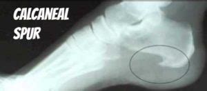 Calcaneal spur treatment, Calcaneal spur homeopathy treatment