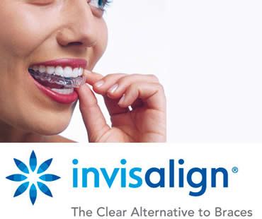 The Invisalign Process - White Marsh Family Dentistry