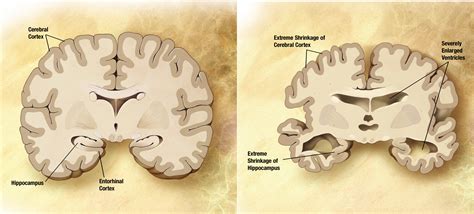 File:Alzheimer's disease brain comparison.jpg - Wikimedia Commons