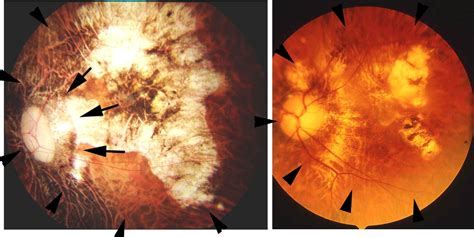 Clinical Characteristics of Posterior Staphyloma in Eyes with Pathologic Myopia - American ...