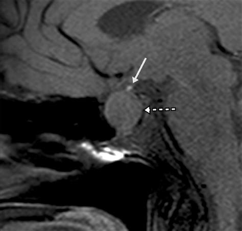 Sagittal T1-weighted MRI sequence with fat saturation, showing an... | Download Scientific Diagram