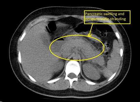 Acute pancreatitis CT - wikidoc