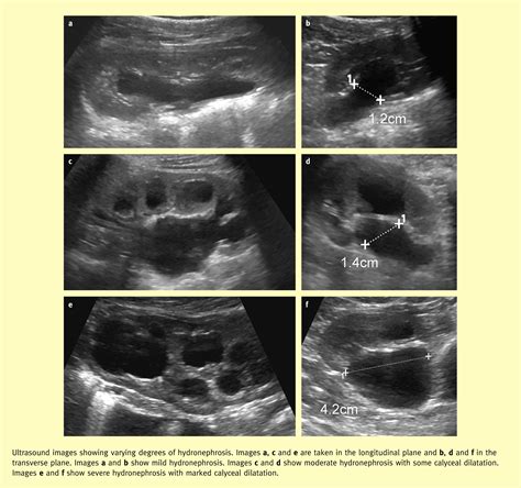 Hydronephrosis in children: pelviureteric junction dysfunction - Surgery - Oxford International ...