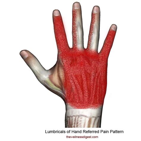 Lumbrical Muscles of Hand: Hand and Finger Pain - The Wellness Digest