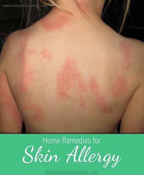 73 best images about Skin Allergy Remedies on Pinterest