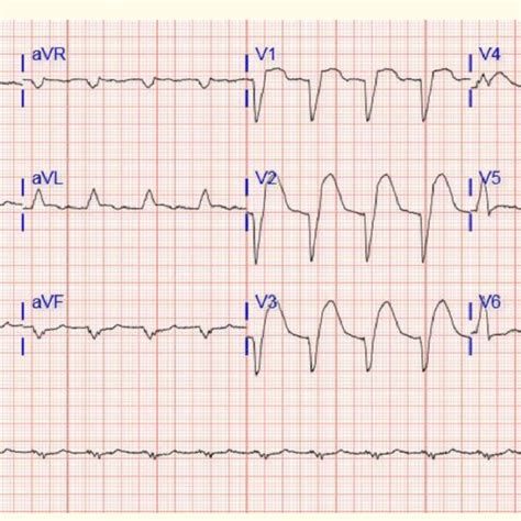 a: Normal sinus rhythm with left bundle branch block. | Download ...