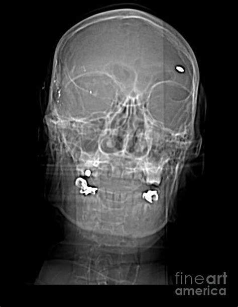 Ct Scout View, Bullet Fragments Photograph by Science Source | Fine Art America