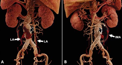 Hyperrealistic Rendering of Type II Endoleak | Radiology