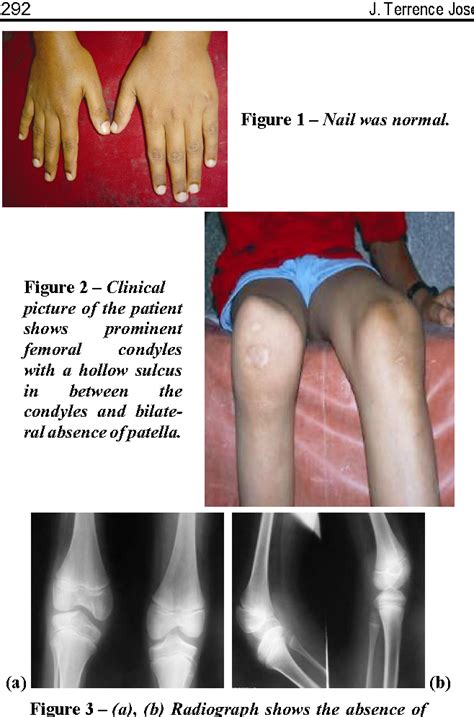 Discover more than 126 nail patella syndrome symptoms latest ...