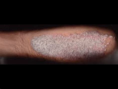 Psoriasis Pictures showing Plaques, Nail pitting and Psoriatic arthritis - YouTube