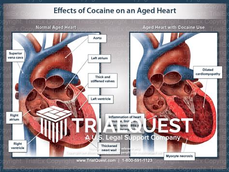 Effects of Cocaine on an Aged Heart - TrialExhibits Inc.