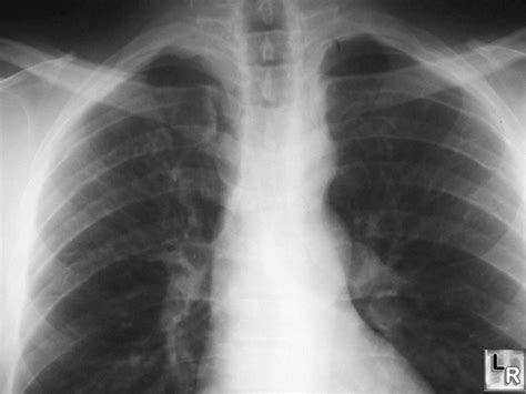 LearningRadiology.com - Coarctation of the Aorta,Aorta,coarctation