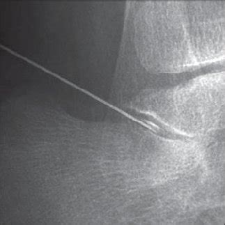 Radiograph shows imaging-guided injections into both talonavicular and... | Download Scientific ...