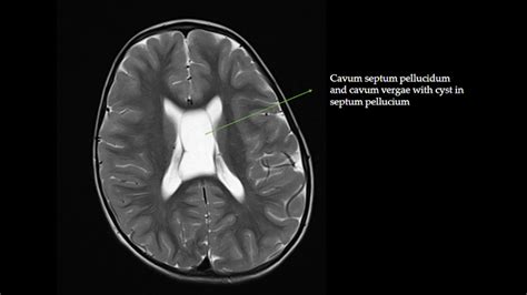 Ultimate Radiology : Arachnoid cyst of Septum Pellucidum