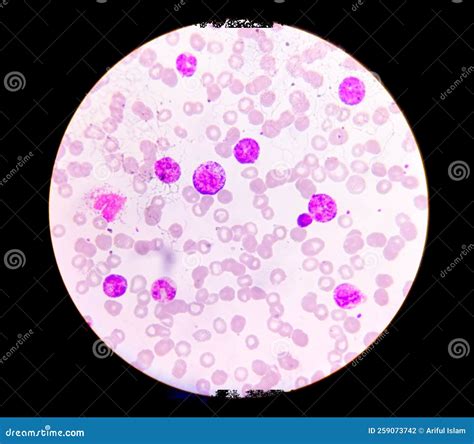 Microscopic Examination of Blasts or Leukemia Cells in Blood Smear of Human. Stock Photo - Image ...