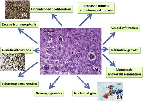 Malignant Melanoma Histology