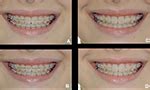 Is there aesthetic difference between the different orthodontic wires ...