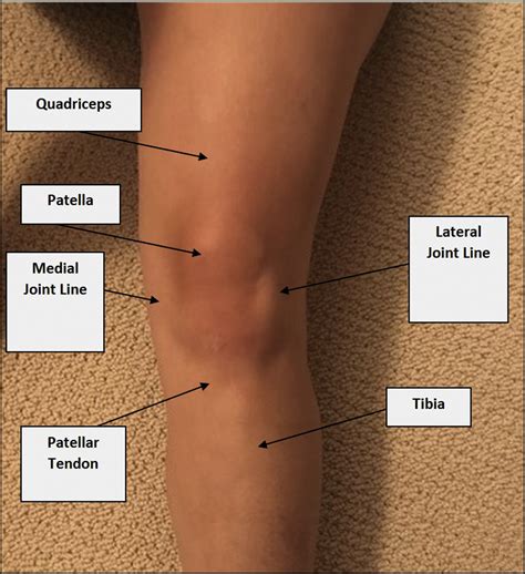Types Of Knee Pain Anterior Posterior Medial Lateral - vrogue.co