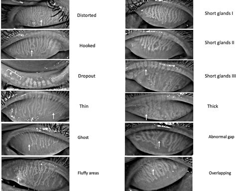 Frontiers | Morphologic variants of Meibomian glands: age-wise distribution and differences ...