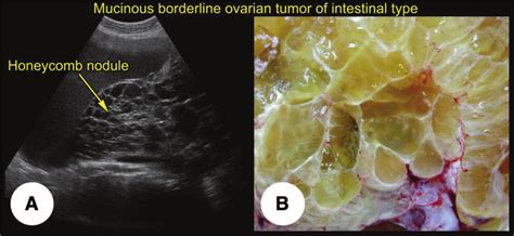 Mucinous borderline tumor of intestinal type (transabdominal scan).... | Download Scientific Diagram