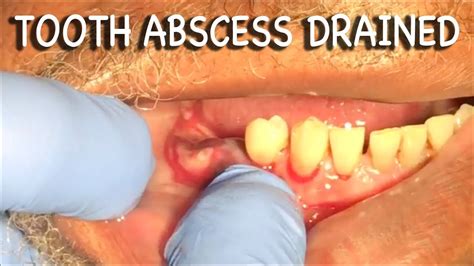 Tooth Abscess Drain