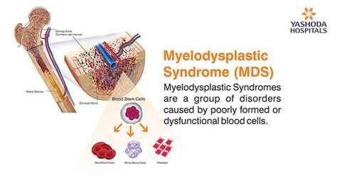 Myelodysplastic Syndrome