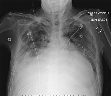 Ap Chest Radiograph Anteroposterior Chest X Ray Revealing Alveolar And ...