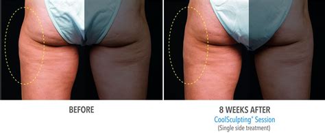 Coolsculpting Outer Thighs: Connecticut Skin Institute First in Connecticut to Offer New ...