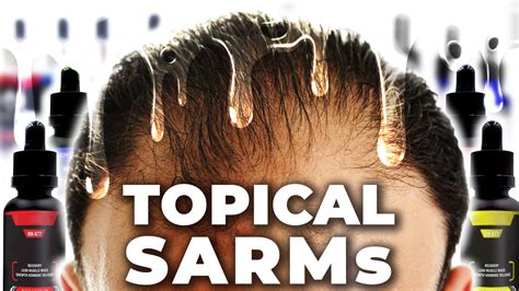 The Therapeutic Promise Of Topical SARMs For Hair Loss Prevention