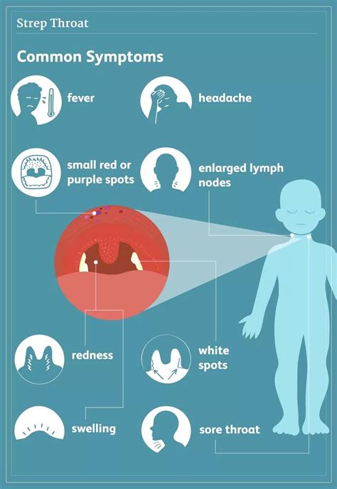 Strep Throat: Symptoms, Treatment and Remedies - Dentist Ahmed