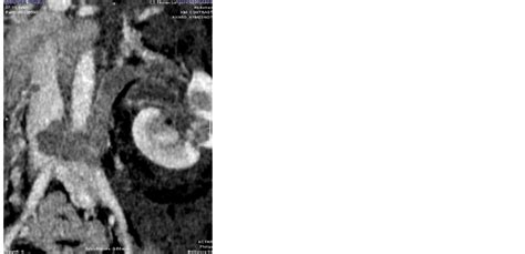 The Mesenteric-Caval Fistula: First Results of a New Technique in a Transperitoneal ...