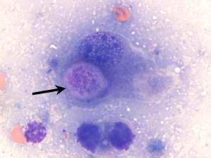 Transitional cell carcinoma (TCC) in a dog | Case Study | Cytopath