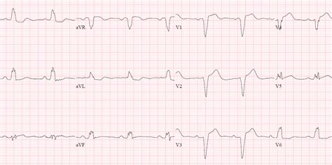 Dr. Smith's ECG Blog: LBBB: Using the (Smith) Modified Sgarbossa Criteria would have saved this ...