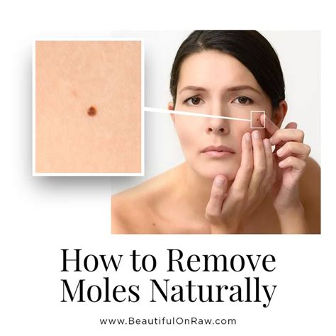 Skin Moles … Removal and Prevention | Beautiful on Raw | Skin moles, Moles on face, Mole removal