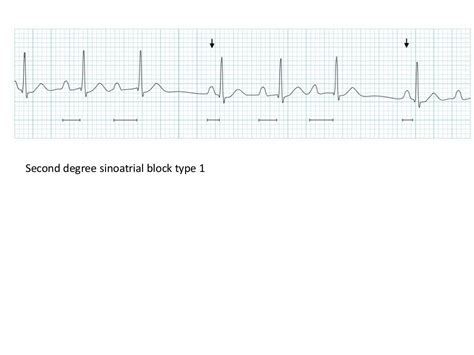 ECG Lecture: Sinus arrest, sinoatrial exit block, AV block and escape…