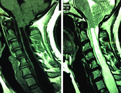 T1 and T2 MRI showing descended cerebellar tonsils and wide syrinx... | Download Scientific Diagram