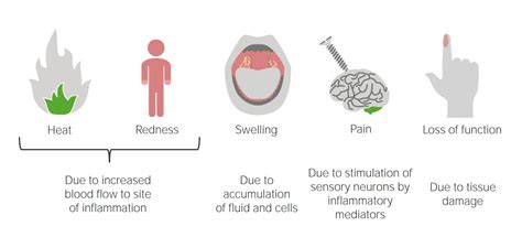 Inflammation | Concise Medical Knowledge