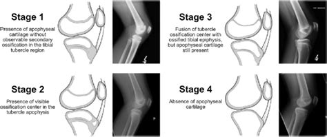 Tibial apophyseal staging schema. | Download Scientific Diagram