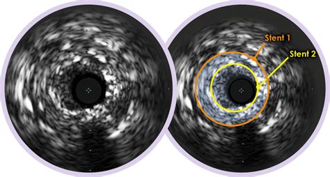 Coronary IVUS - Intravascular Ultrasound | Philips