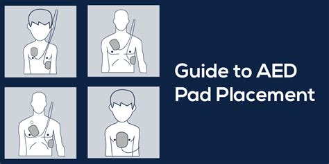 Anteroposterior Aed Placement