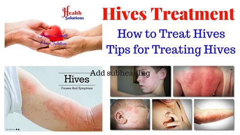 Urticaria Hives Treatment